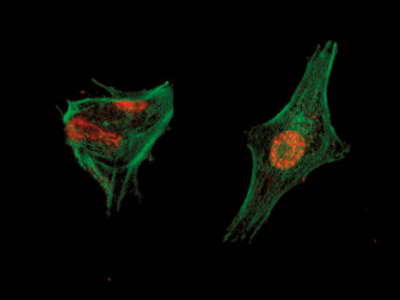 Actualidad científica: adenovirus oncolíticos de diseño para eliminar la metástasis de cáncer colorrectal