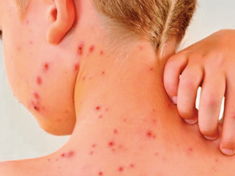 Sarampión, tos ferina y sífilis: Reemergencia de enfermedades infecciosas prevenibles