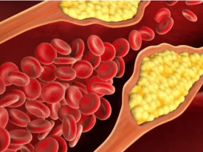 Actualidad científica: Un hallazgo clave en el conocimiento de la aterosclerosis