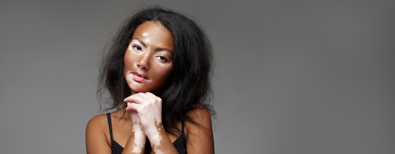 La AMP conmemora el Día Mundial del Vitiligo